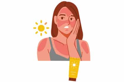 Illustration einer Frau mit starkem Sonnenbrand im Gesicht und an den Schultern sowie einer Sonnencreme-Tube als Symbol für UV-Schutz.