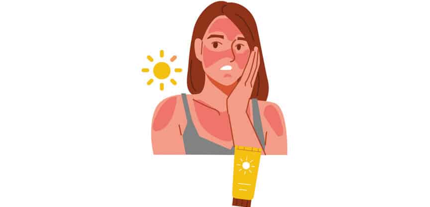 Illustration einer Frau mit starkem Sonnenbrand im Gesicht und an den Schultern sowie einer Sonnencreme-Tube als Symbol für UV-Schutz.