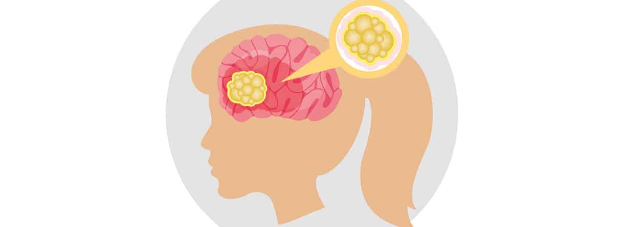 Illustration eines Gehirns mit hervorgehobenem Tumor und vergrößerter Darstellung von Krebszellen.