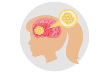 Illustration eines Gehirns mit hervorgehobenem Tumor und vergrößerter Darstellung von Krebszellen.