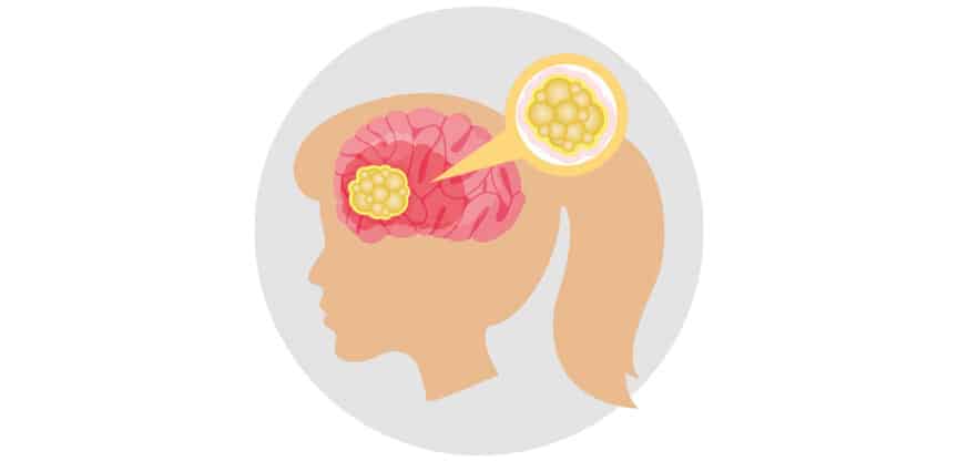 Illustration eines Gehirns mit hervorgehobenem Tumor und vergrößerter Darstellung von Krebszellen.