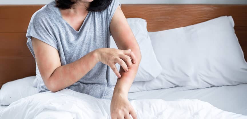 Person kratzt sich wegen geröteter, juckender Hautstellen am Arm und Ellenbogen – Symbolbild für Hautreizungen, Ekzeme oder Allergien.