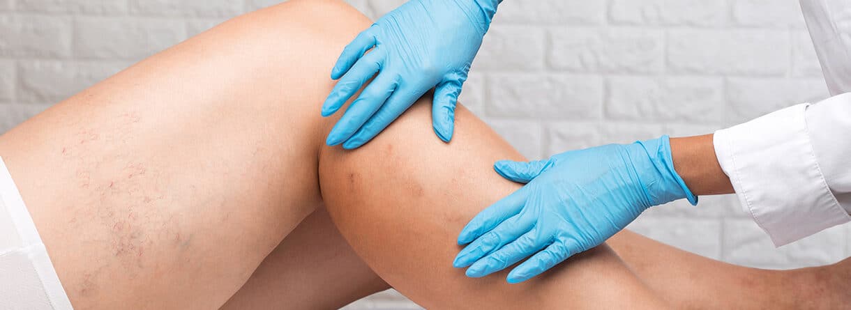Ärztin untersucht das Knie einer Patientin mit Krampfadern – medizinische Kontrolle der Beingesundheit und des Venensystems.