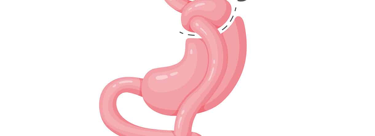 Illustration einer Schlauchmagen-Operation mit chirurgischer Verkleinerung des Magens – Symbolbild für bariatrische Chirurgie und Adipositasbehandlung.