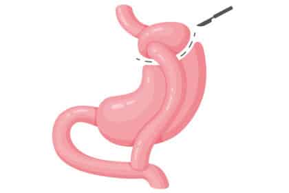 Illustration einer Schlauchmagen-Operation mit chirurgischer Verkleinerung des Magens – Symbolbild für bariatrische Chirurgie und Adipositasbehandlung.