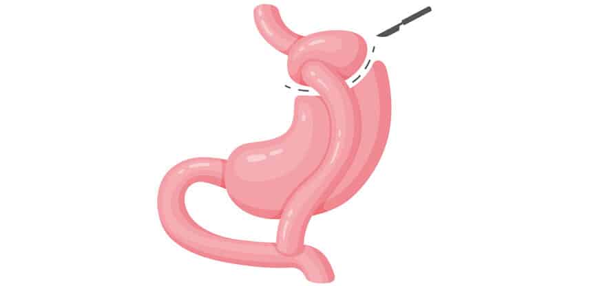 Illustration einer Schlauchmagen-Operation mit chirurgischer Verkleinerung des Magens – Symbolbild für bariatrische Chirurgie und Adipositasbehandlung.