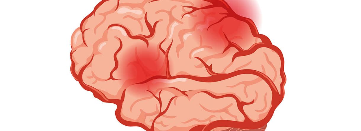 Illustration eines Gehirns mit rot markierten Entzündungsherden – Symbolbild für Hirnentzündungen, neurologische Erkrankungen und Entzündungsprozesse.