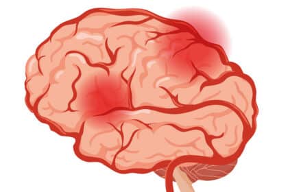 Illustration eines Gehirns mit rot markierten Entzündungsherden – Symbolbild für Hirnentzündungen, neurologische Erkrankungen und Entzündungsprozesse.