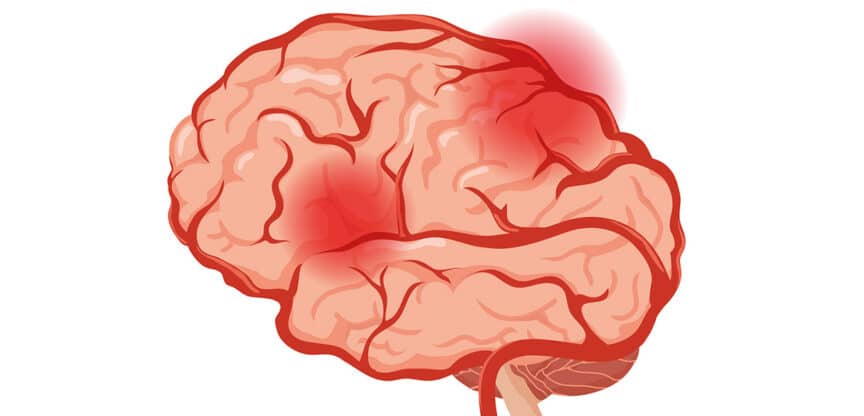 Illustration eines Gehirns mit rot markierten Entzündungsherden – Symbolbild für Hirnentzündungen, neurologische Erkrankungen und Entzündungsprozesse.