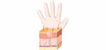Illustration eines Hautquerschnitts mit Haarfollikel sowie einer Hand mit kleinen Bläschen – Darstellung von Hauterkrankungen oder Hautreaktionen.