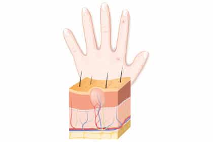 Illustration eines Hautquerschnitts mit Haarfollikel sowie einer Hand mit kleinen Bläschen – Darstellung von Hauterkrankungen oder Hautreaktionen.