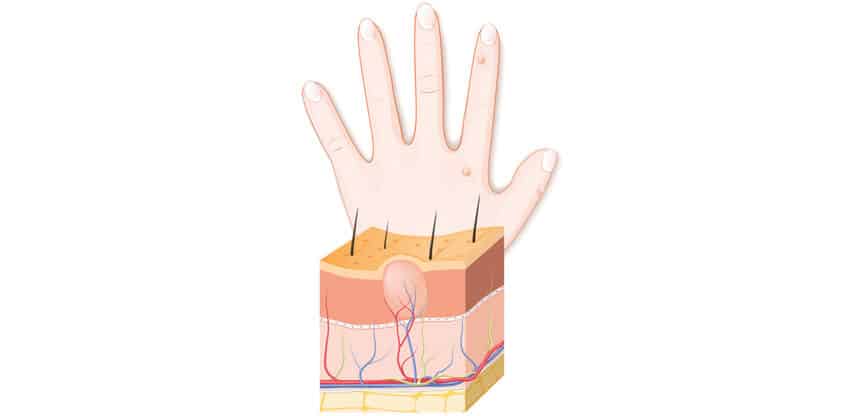 Illustration eines Hautquerschnitts mit Haarfollikel sowie einer Hand mit kleinen Bläschen – Darstellung von Hauterkrankungen oder Hautreaktionen.