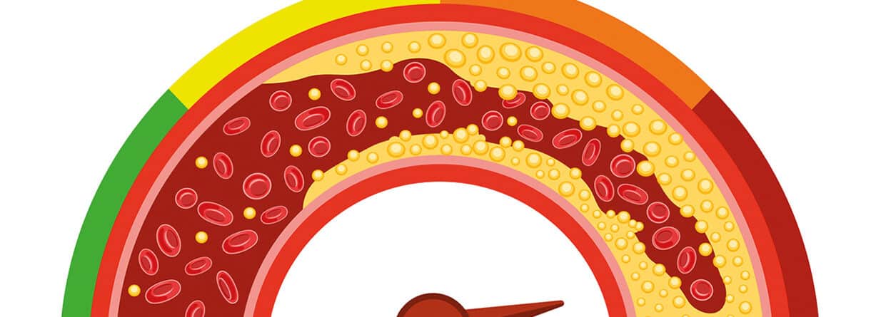 Illustration eines verengten Blutgefäßes mit Fettablagerungen als Darstellung von Arteriosklerose.