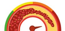 Illustration eines verengten Blutgefäßes mit Fettablagerungen als Darstellung von Arteriosklerose.