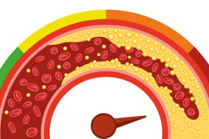 Illustration eines verengten Blutgefäßes mit Fettablagerungen als Darstellung von Arteriosklerose.