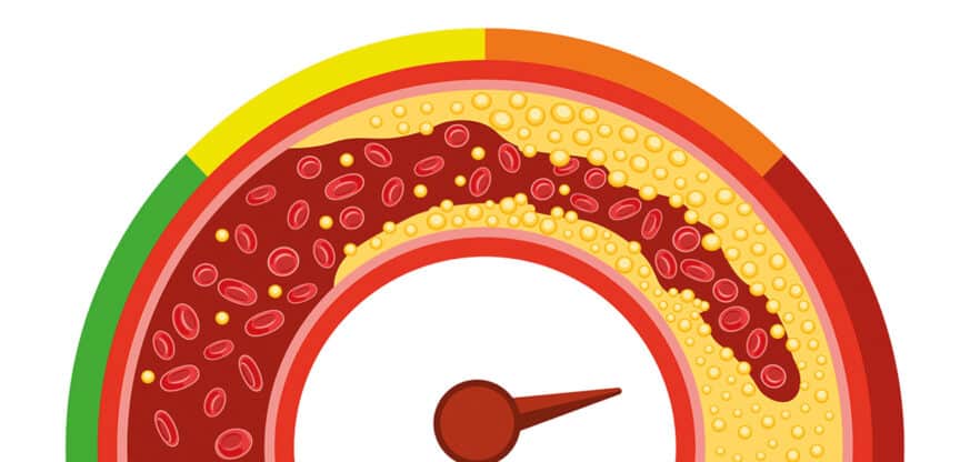 Illustration eines verengten Blutgefäßes mit Fettablagerungen als Darstellung von Arteriosklerose.